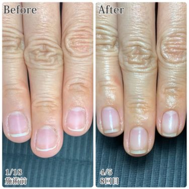 03-8　　ささくれ・皮膚あれ　育成前・結果